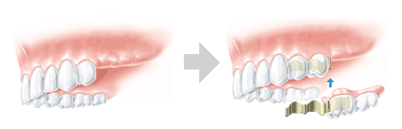 従来の取り外し式部分入れ歯の治療
