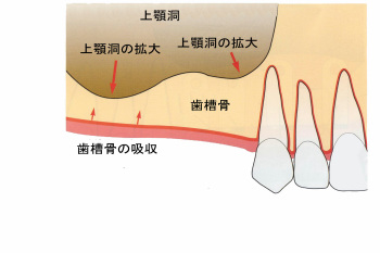 サイナスリフト（上顎洞底挙上術） - 徳島インプラントセンター